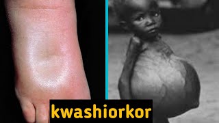 kwashiorkor and its symptoms [upl. by Asilegna667]