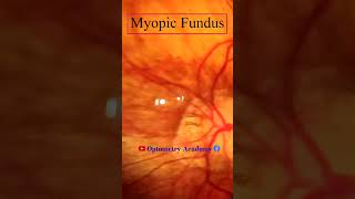 Myopic Fundus  Fundus Photography  Myopic Crescent  Short Video 141 viral optometryacademy [upl. by Erbas]