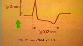 ECG Normal  Electro Cardiograma Normal [upl. by Ydne]