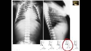 Embryology of Congenital Anomalies of the Foregut 1 [upl. by Aneleasor]