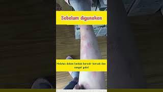 Krim dermatitis atopik Atoskin [upl. by Semela]