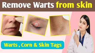 warts homeopathy medicine  warts removal on face  warts Corn  skin tag treatment [upl. by Maisie]