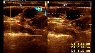 Cervical Lymphadenopathy  Normal Thyroid Gland  Ultrasound Cervical Lymph Node [upl. by Oglesby810]