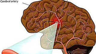 Intracerebral HemorrhageICHEtiology PathophysiologyClinical Features Diagnostic Treatment [upl. by Justicz373]