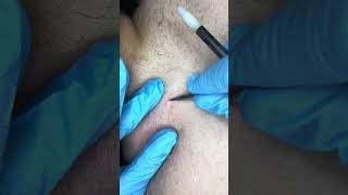 Watch electrolysis Back hairs permanent hair removal [upl. by Vel]