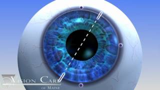 Alcon Toric Lens at Vision Care of Maine [upl. by Conroy409]