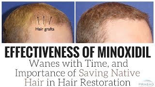 How Effects of Minoxidil Wane Over Time and Importance of Saving Native Hair in Hair Transplants [upl. by Nonnahs570]