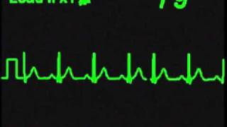 Normal Sinus Rhythm  NSR  ECG Simulator  Arrhythmia Simulator [upl. by Anifesoj869]