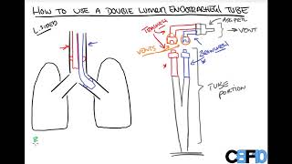 How to use a Double Lumen Endotracheal Tube [upl. by Emmuela787]