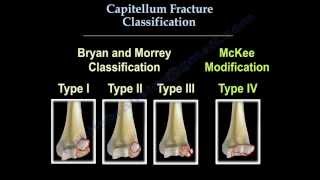 Capitellum Fracture Classification  Everything You Need To Know  Dr Nabil Ebraheim [upl. by Nylecsoj614]