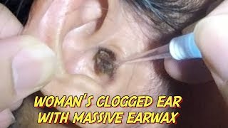 Womans Clogged Ear with Massive Earwax is Finally Removed [upl. by Ardnael]