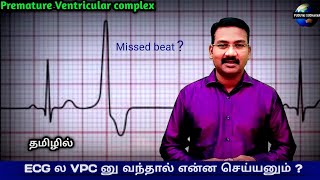 Ventricular Ectopic tamil  Ventricular Premature complex  Premature beat ECG Arrhythmias tamil [upl. by Durrace668]