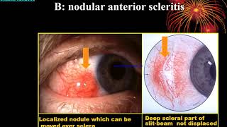 Sclera Lect By Dr Abdul Basir Safi 1 [upl. by Ephrayim]