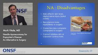 Needle Aponeurotomy An Alternative to Surgery for Dupuytrens Disease [upl. by Beitch]