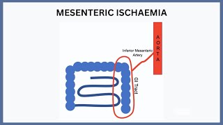 Mesenteric Ischaemia Explained [upl. by Acinna]