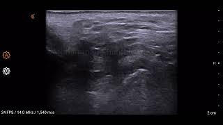 TMJ Ultrasound Disc Displacement with Reduction [upl. by Leasa]