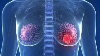 Diferencias de aplicar radiociugía con un acelerador lineal vs otros equipos de radioterapia [upl. by Lynna512]