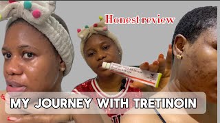 5 months of using Tretinoin on my face  must watch for acne prone skin acnetreatment [upl. by Ramsden648]