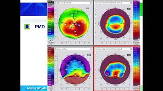 Quick guide to reading corneal tomography Part 6 [upl. by Vitus936]