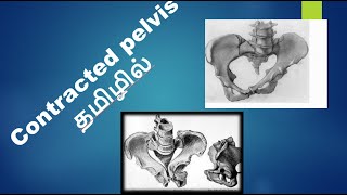 Contracted pelvis Explained in தமிழ் [upl. by Austine199]