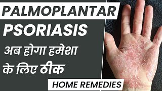 How To Control Palmoplantar Psoriasis at Home  Palmoplantar Psoriasis का इलाज कैसे करें [upl. by Ackerley311]