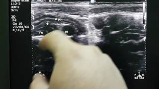 Mesenteric Lymphadenitis Sonography [upl. by England]