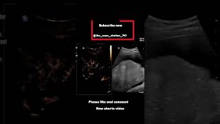 Hepatocellular carcinomadoctor ultrasound pregnant pediatrician baby abdomen pregnancyjourney [upl. by Ayek815]