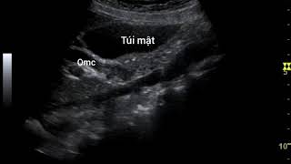 Case 133  Choledocholithiasis  sỏi ống mật chủ [upl. by Atsejam]