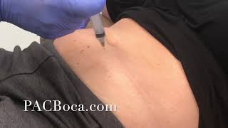 Lipolysis Injections Dr Sharabi PACBocacom [upl. by Aciraa863]