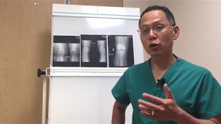 How To Read An Xray Of Your Knee [upl. by Edrahc]