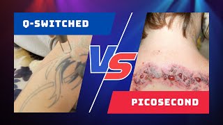 Picosecond VS Q Switched Lasers  Whats The Difference [upl. by Akemahc363]