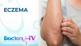 Eczema Symptoms Causes and Treatment  Doctors on TV [upl. by Ititrefen592]