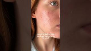 Riktig hud utan filter🥰☁️commonclouds realskin riktighud aknebenägenhud acne akne finnar [upl. by Aicxela]