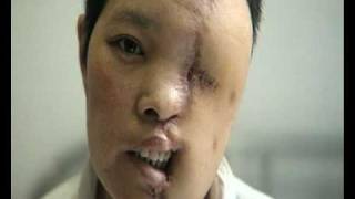 My Shocking Story Human Face Transplant  Gou Shuzong [upl. by Tareyn]