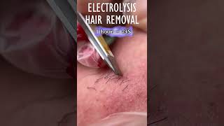 Electrolysis Hair Removal [upl. by Nosremaj565]