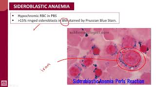 Hematology  1  U8L4  Sideroblastic anaemia [upl. by Honoria]