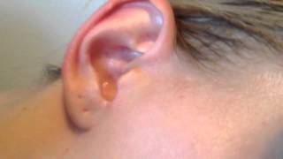 ear  hydrogen peroxide [upl. by Romilly]