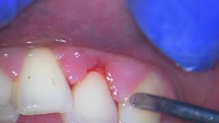 Ultrasonic teeth cleaning watch why your gums bleed [upl. by Ellevel]