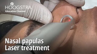 Nasal papulas  Laser treatment  23040 [upl. by Chucho347]