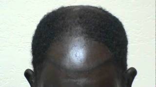 Hair Transplant Restoring Black African American Frontal Bald High Hairline wwwmhtacliniccom [upl. by Oos]