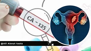 Understanding CA 125 Test Ovarian Cancer Doctor Explains [upl. by Sutit]