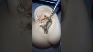 Removal Earwax 2 [upl. by Walford]