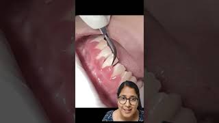 GINGIVAL INFLAMMATION  GINGIVITIS  shortsfeed youtubeshorts dentalclinic AS dental care viral [upl. by Lledor684]