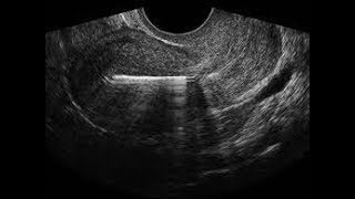 Ultrasonographic assessment of IUD position [upl. by Alletsyrc]