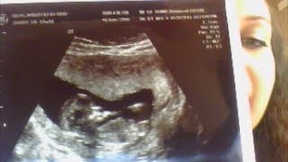 Ultrasound NT amp Down Syndrome Test  12 Weeks Pregnant [upl. by Adnolrehs]