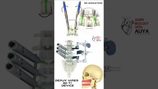 Depuy Viper 3D T1 Device 3d animation short [upl. by Hgielanna865]