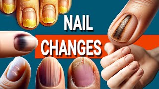 13 Nail Changes and What They Mean for Your Health [upl. by Nylloc]