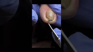 Easy way to remove deep ingrown toenail [upl. by Libbna]