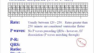 ECG Ventricular Tachycardia VT [upl. by Crosse]