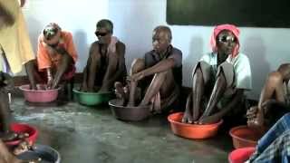 LepClip Hindi 09 Disabilities due to Leprosy [upl. by Nitz]